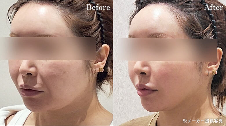 オールタイト症例