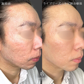 ローリング型のクレーター治療のビフォーアフター３