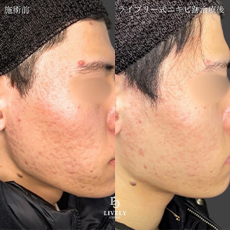 ローリング型のクレーター治療のビフォーアフター４