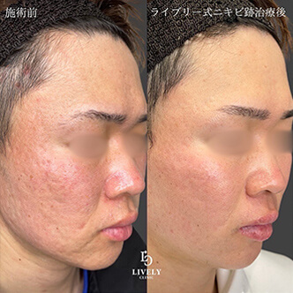 ローリング型のクレーター治療のビフォーアフター２