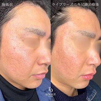 アイスピック型のクレーター治療のビフォーアフター１