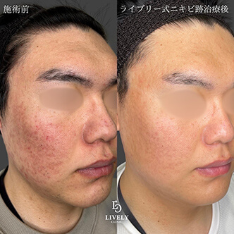 ローリング型のクレーター治療のビフォーアフター１