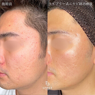 ボックス型のクレーター治療のビフォーアフター２