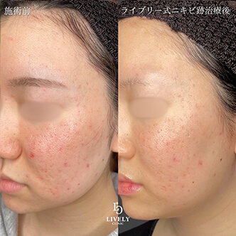 アイスピック型のクレーター治療のビフォーアフター３