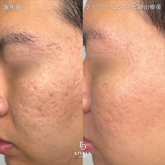 ボックス型のクレーター治療のビフォーアフター３