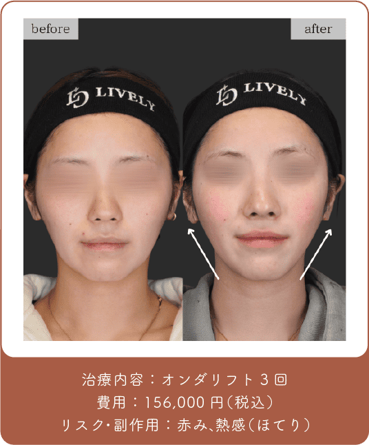 オンダリフト