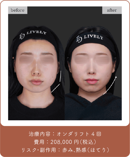 オンダリフト