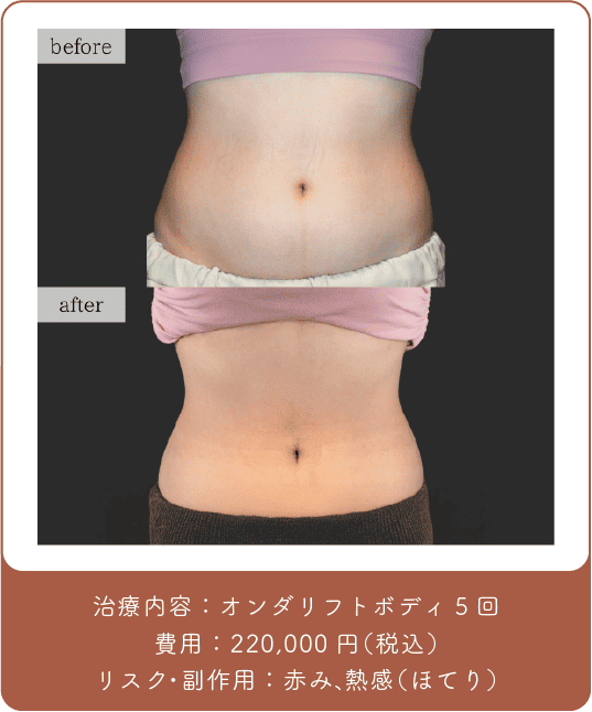 オンダリフト