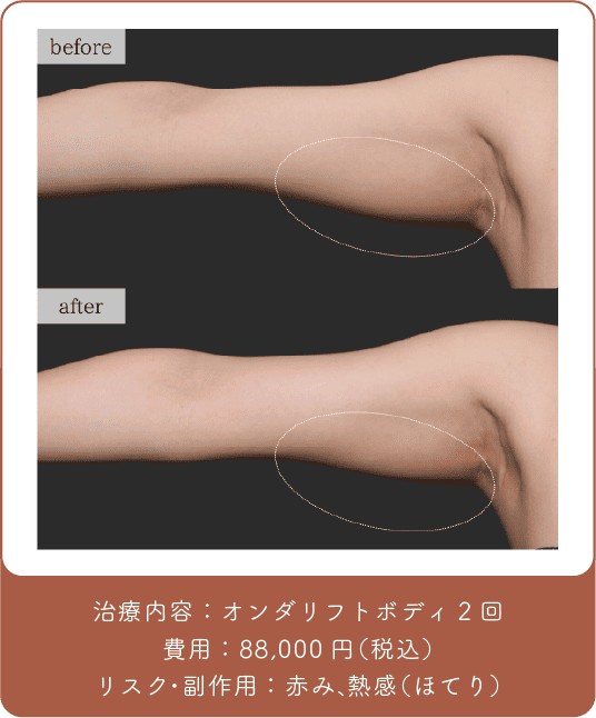 オンダリフト