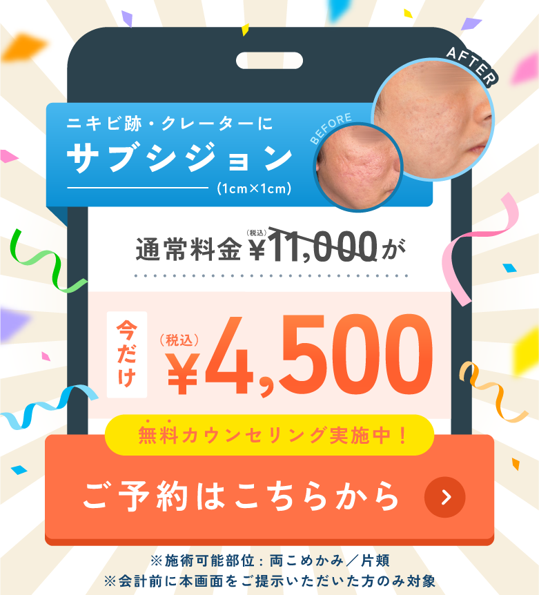ニキビ跡・クレーターにサブシジョン 4,500円 ご予約はこちらから