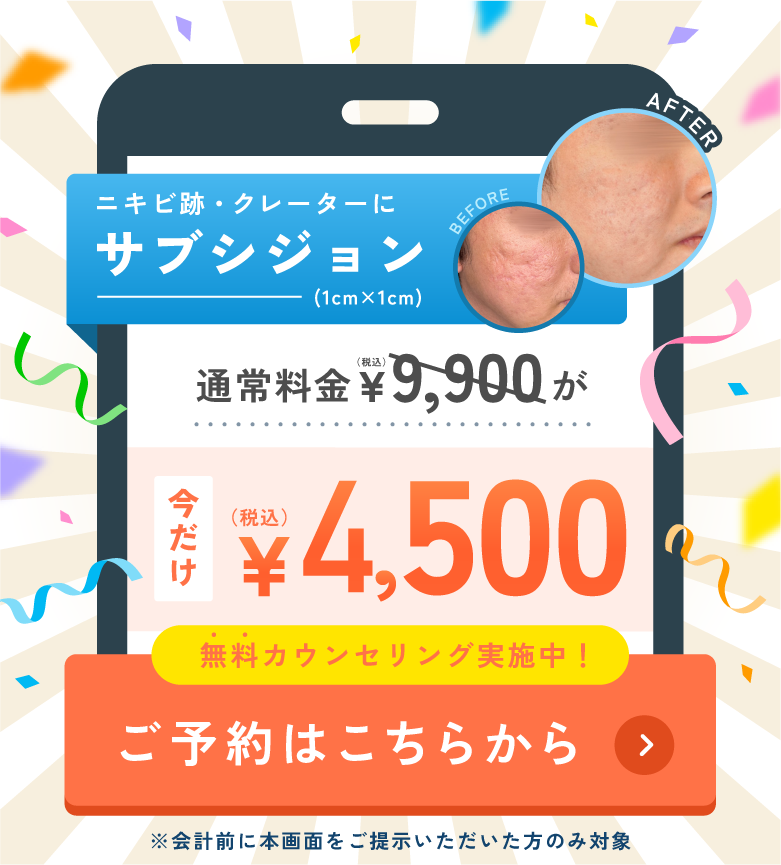 ニキビ跡・クレーターにサブシジョン 5,500円 ご予約はこちらから