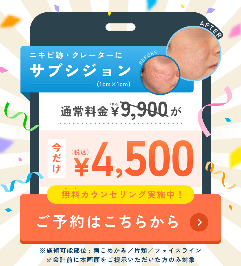 ニキビ跡・クレーターにサブシジョン 5,500円 ご予約はこちらから