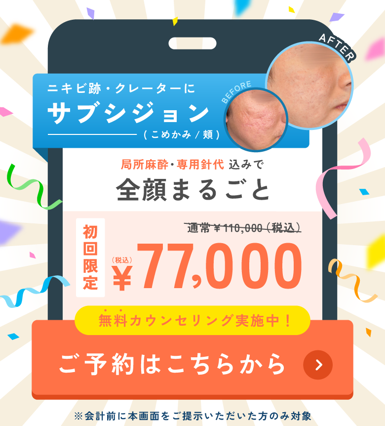 ニキビ跡・クレーターにサブシジョン ご予約はこちらから
