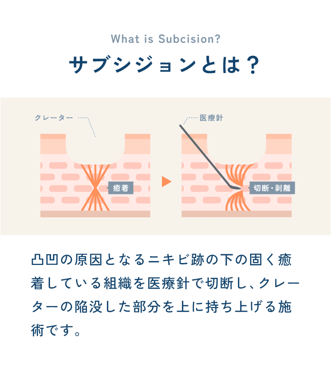 サブシジョンとは