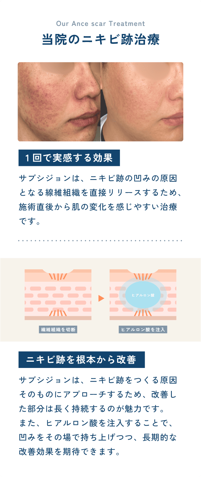 当院のニキビ跡治療