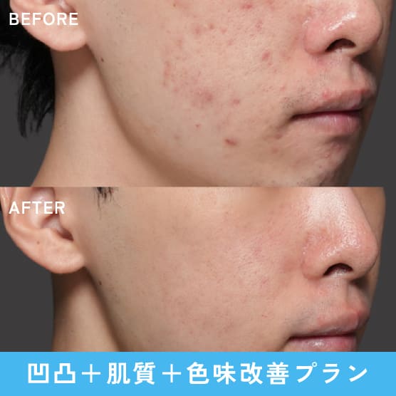 凹凸+肌質+色味改善プラン