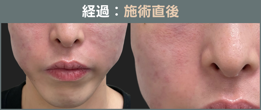 サブシジョンの経過直後