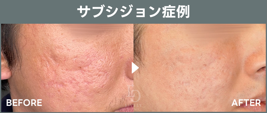 サブシジョンによる症例