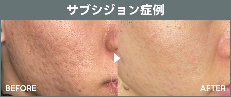 サブシジョンによる症例