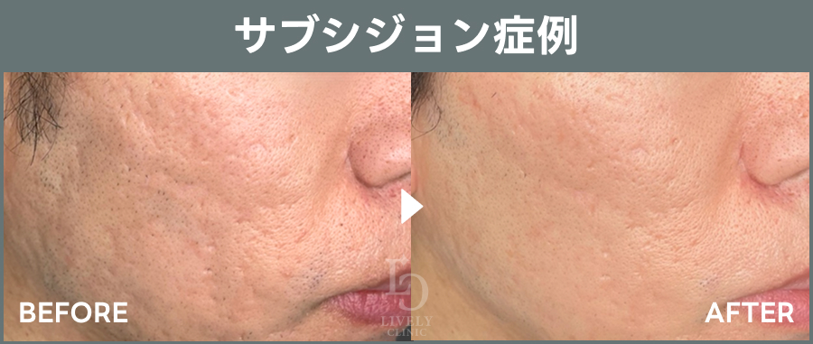 サブシジョンによる症例