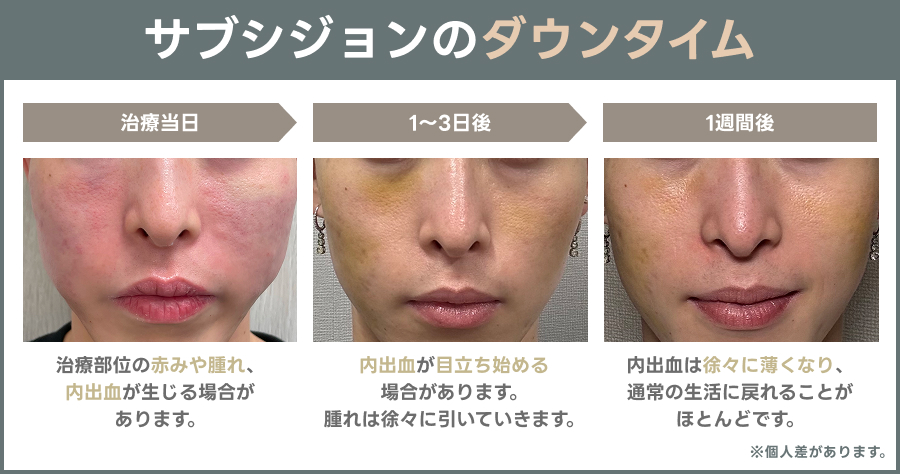 サブシジョンのダウンタイム