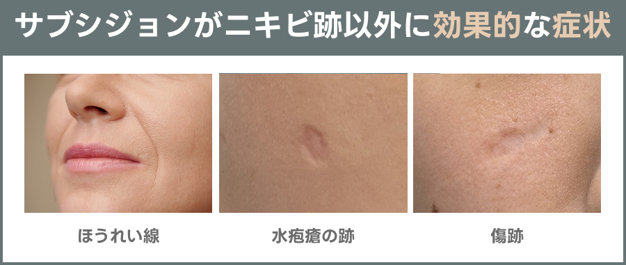 サブシジョンがニキビ跡以外に効果的な症状