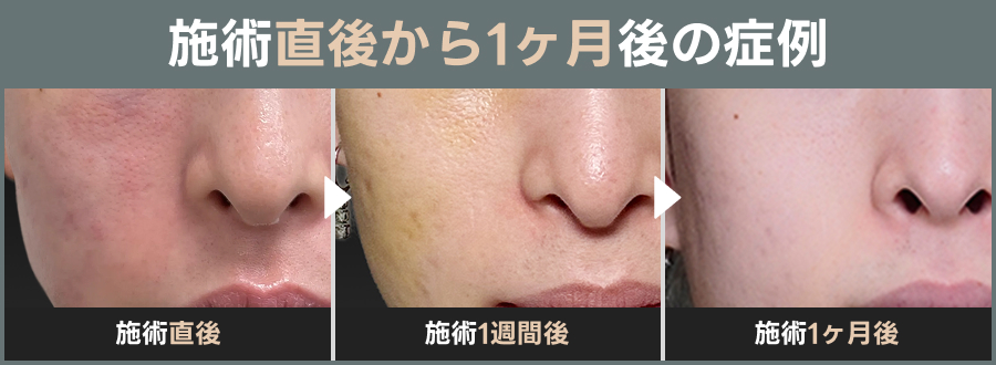 サブシジョンの施術直後から1ヶ月後の症例