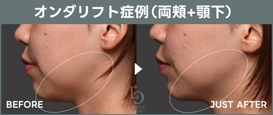 オンダリフト症例（両頬＋顎下）