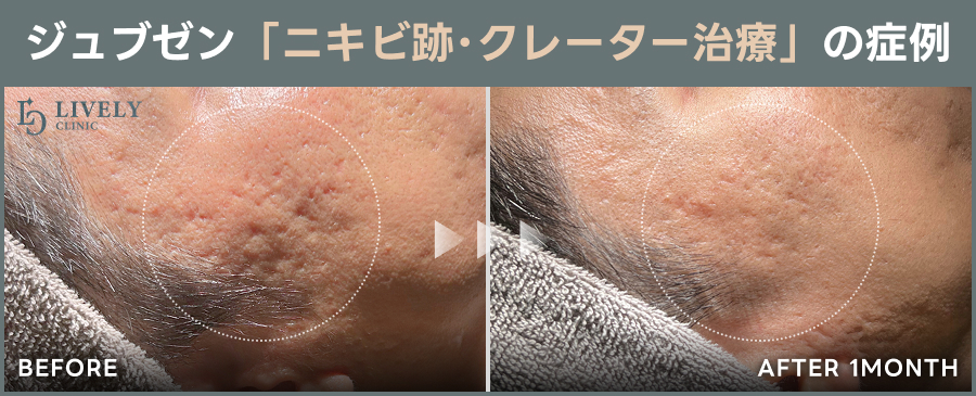 ライブリークリニックのジュブゼン「ニキビ跡」の症例画像
