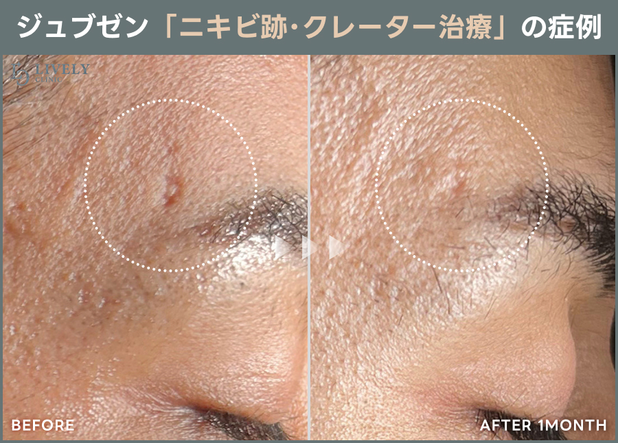 ライブリークリニックのジュブゼン「クレーター治療」の症例画像