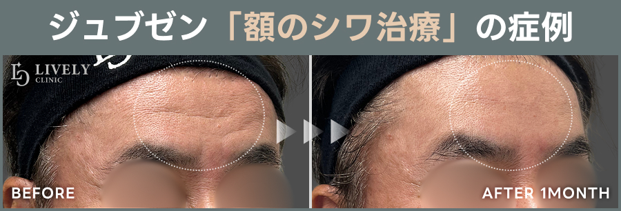 ライブリークリニックのジュブゼン「額のシワ治療」の症例画像