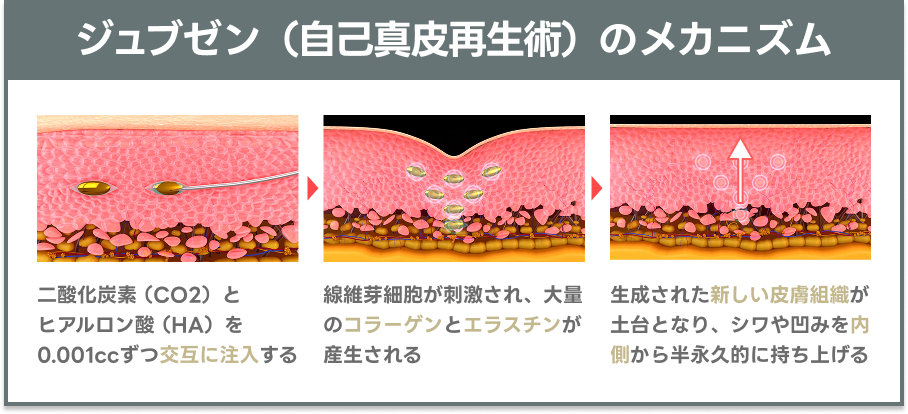 ジュブゼン（JUVGEN）自己真皮再生術の仕組みを解説