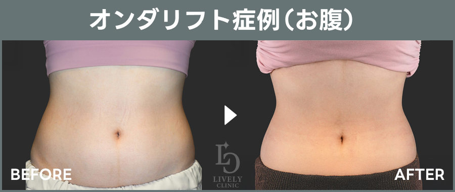 オンダリフトの症例写真
