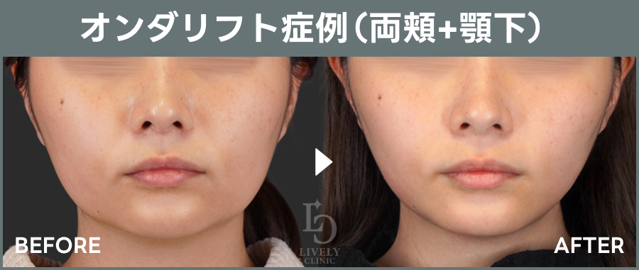 オンダリフトの症例写真