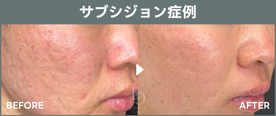 サブシジョンの症例