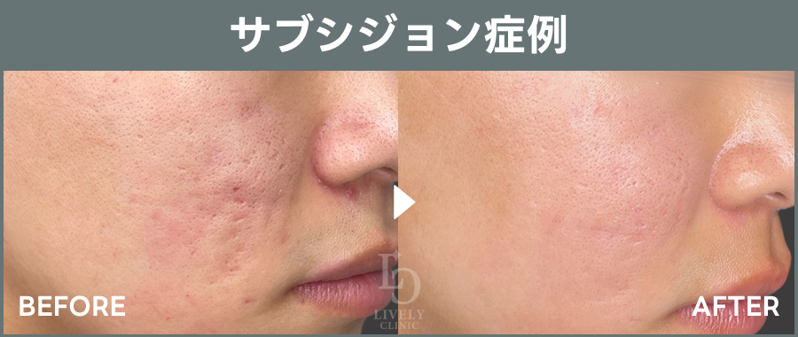 サブシジョンの症例