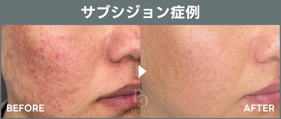 サブシジョンの症例