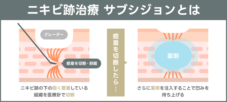 サブシジョンとは