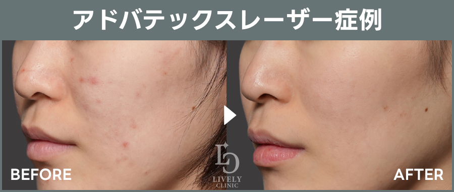 アドバテックスレーザーのBefore After｜ライブリークリニック