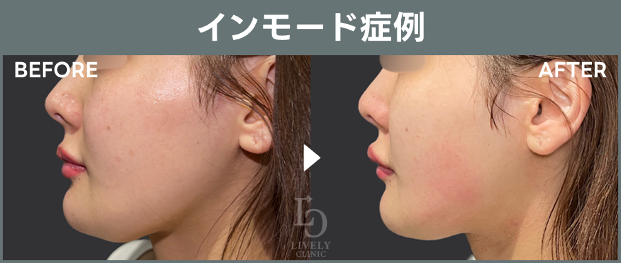 【インモード】のBefore After写真｜ライブリークリニック