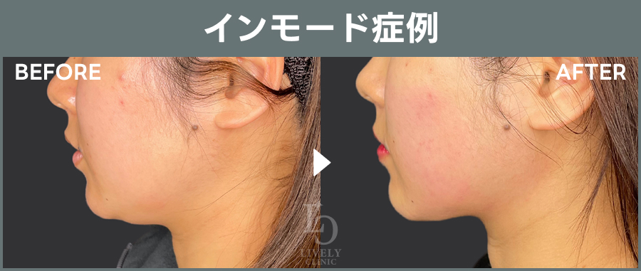 【インモード】のBefore After写真｜ライブリークリニック