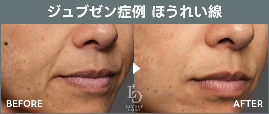 ジュブゼンのほうれい線治療のBefore After｜ライブリークリニック