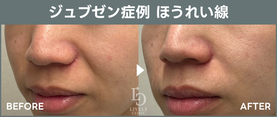 ジュブゼンのほうれい線治療のBefore After｜ライブリークリニック
