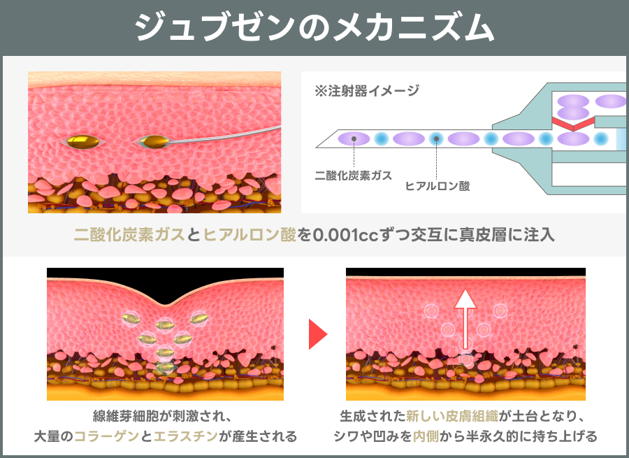 ジュブゼン（自己真皮再生術）の仕組みを示す説明図｜ライブリークリニック
