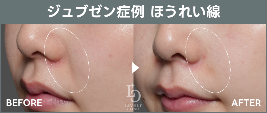 ジュブゼンのほうれい線治療のBefore After｜ライブリークリニック