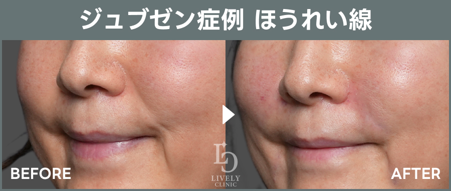 ジュブゼンのほうれい線治療のBefore After｜ライブリークリニック