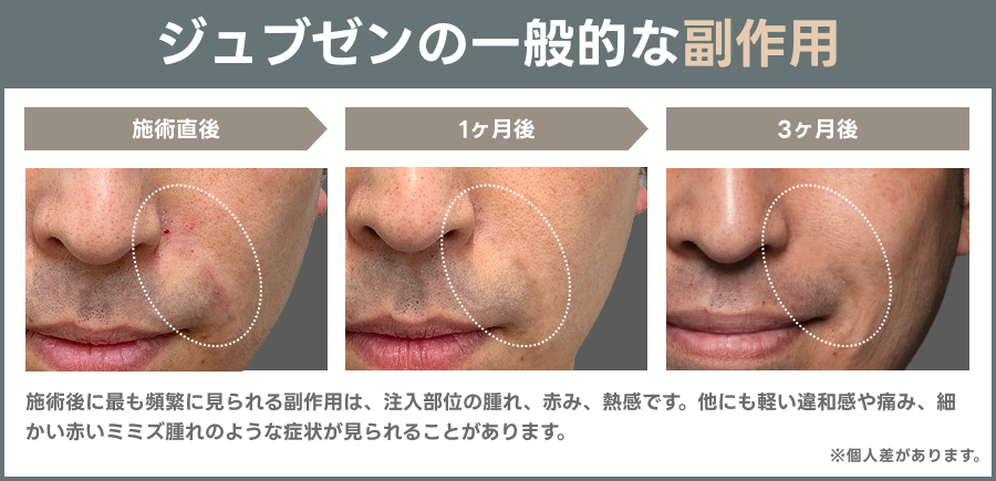 ジュブゼン（自己真皮再生術）の一般的な副作用を示した解説図｜ライブリークリニック
