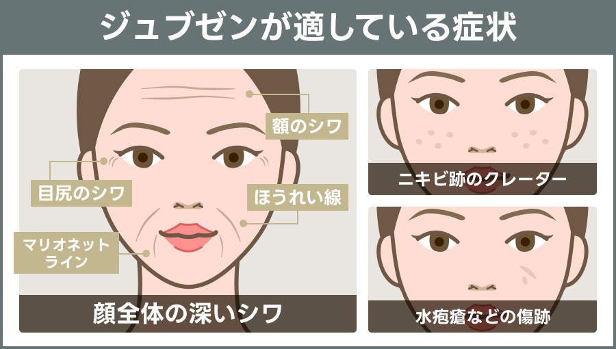 ジュブゼン（自己真皮再生術）が適している症状を示す説明図｜ライブリークリニック
