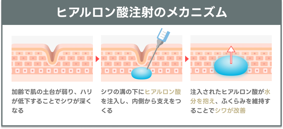ヒアルロン酸注射の仕組みを示す説明図｜ライブリークリニック
