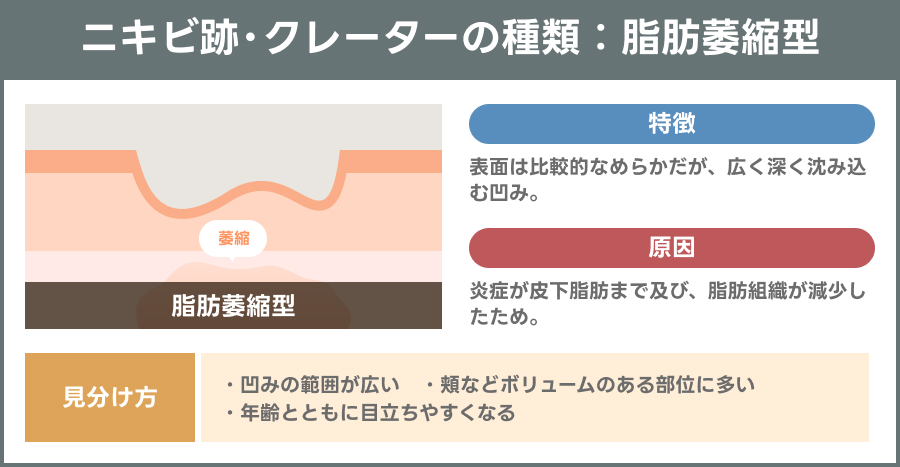 脂肪萎縮型のニキビ跡・クレーターを示す説明図｜ライブリークリニック